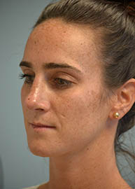 Rhinoplasty Before and After Pictures Philadelphia, PA