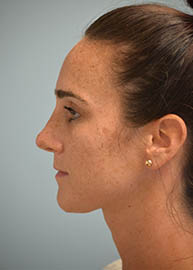 Rhinoplasty Before and After Pictures Philadelphia, PA