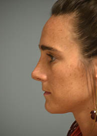 Rhinoplasty Before and After Pictures Philadelphia, PA