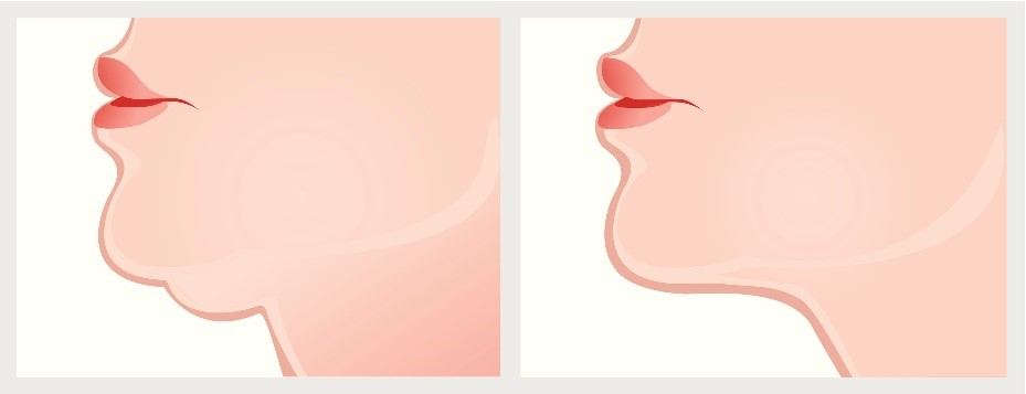 Facial Liposuction in Philadelphia, PA