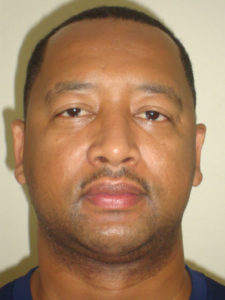 Chin Augmentation Before and After Pictures Philadelphia, PA