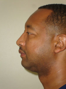Chin Augmentation Before and After Pictures Philadelphia, PA