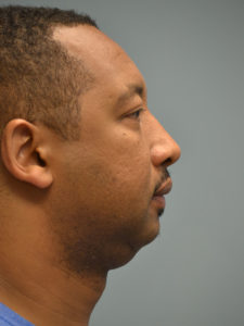 Chin Augmentation Before and After Pictures Philadelphia, PA