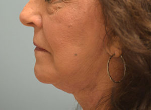 Facelift Before and After Pictures in Philadelphia, PA