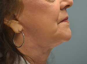 Facelift Before and After Pictures in Philadelphia, PA