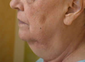 Facelift Before and After Pictures in Philadelphia, PA