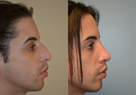 African American Rhinoplasty Atlanta, GA - Premier Image - DrDaraei