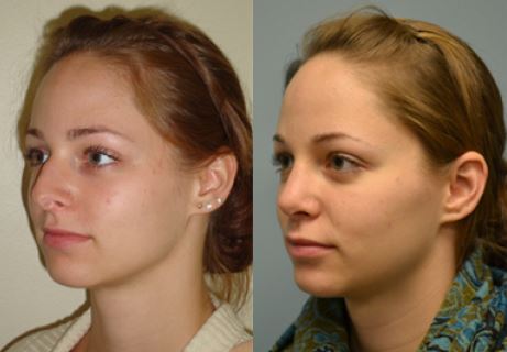 Rhinoplasty Before and After Pictures Philadelphia, PA