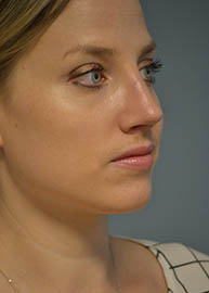 Rhinoplasty Before and After Pictures in Philadelphia, PA