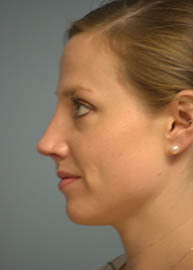 Rhinoplasty Before and After Pictures in Philadelphia, PA