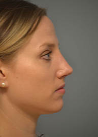 Rhinoplasty Before and After Pictures in Philadelphia, PA