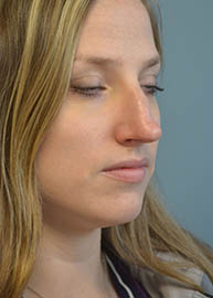 Rhinoplasty Before and After Pictures in Philadelphia, PA