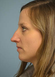 Rhinoplasty Before and After Pictures in Philadelphia, PA