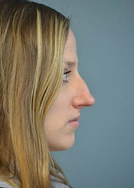 Rhinoplasty Before and After Pictures in Philadelphia, PA