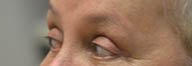 Eyelid Surgery Before and After Pictures in Philadelphia, PA