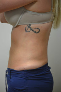 Liposuction Before and After Pictures in Philadelphia, PA