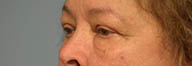 Eyelid Surgery Before and After Pictures in Philadelphia, PA