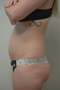 Liposuction Before and After Pictures in Philadelphia, PA