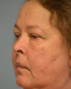 Brow Lift Before and After Pictures Philadelphia, PA