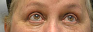 Eyelid Surgery Before and After Pictures in Philadelphia, PA