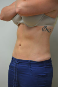 Liposuction Before and After Pictures in Philadelphia, PA