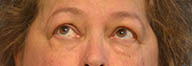Eyelid Surgery Before and After Pictures in Philadelphia, PA