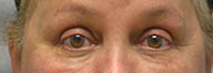 Eyelid Surgery Before and After Pictures in Philadelphia, PA