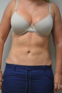 Liposuction Before and After Pictures in Philadelphia, PA