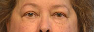 Eyelid Surgery Before and After Pictures in Philadelphia, PA