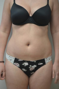Liposuction Before and After Pictures in Philadelphia, PA