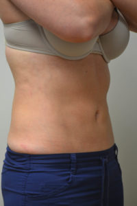 Liposuction Before and After Pictures in Philadelphia, PA