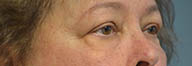 Eyelid Surgery Before and After Pictures in Philadelphia, PA