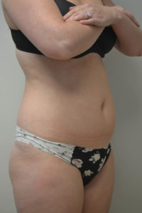 Liposuction Before and After Pictures in Philadelphia, PA