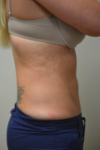 Liposuction Before and After Pictures in Philadelphia, PA