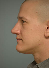 Rhinoplasty Before and After Pictures in Philadelphia, PA