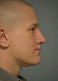 Rhinoplasty Before and After Pictures in Philadelphia, PA