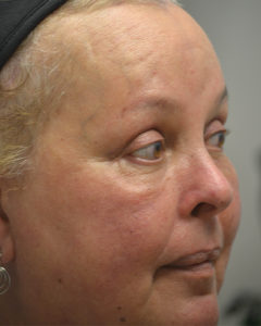 Brow Lift Before and After Pictures Philadelphia, PA