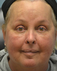 Brow Lift Before and After Pictures Philadelphia, PA