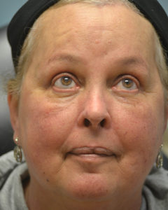 Brow Lift Before and After Pictures Philadelphia, PA