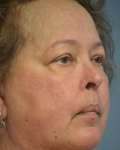 Brow Lift Before and After Pictures Philadelphia, PA