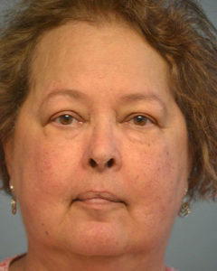 Brow Lift Before and After Pictures Philadelphia, PA