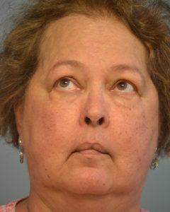Brow Lift Before and After Pictures Philadelphia, PA