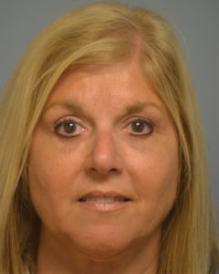 Blepharoplasty Before and After Pictures Philadelphia, PA