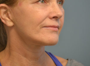 Facelift Before and After Pictures in Philadelphia, PA