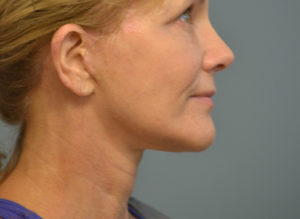 Facelift Before and After Pictures in Philadelphia, PA