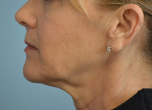 Facelift Before and After Pictures in Philadelphia, PA