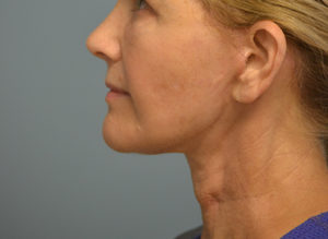 Facelift Before and After Pictures in Philadelphia, PA