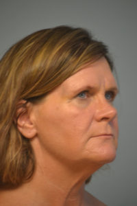 Neck lift Before and After Pictures Philadelphia, PA