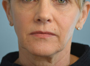 Facelift Before and After Pictures in Philadelphia, PA