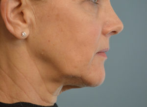 Facelift Before and After Pictures in Philadelphia, PA